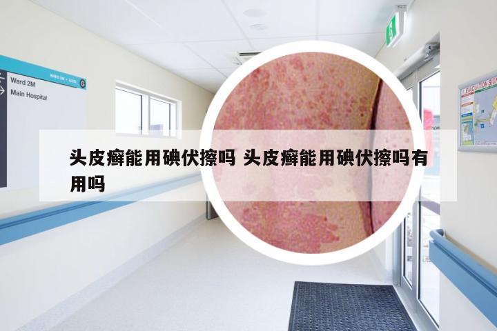 头皮癣能用碘伏擦吗 头皮癣能用碘伏擦吗有用吗