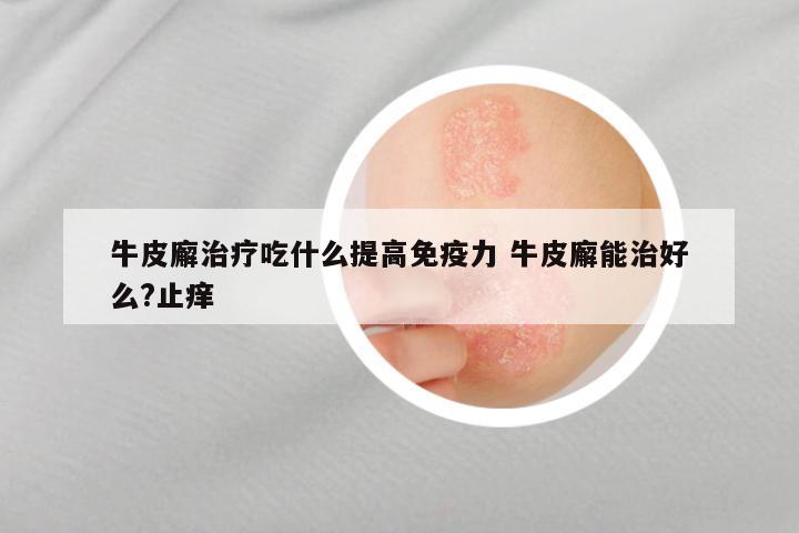 牛皮廨治疗吃什么提高免疫力 牛皮廨能治好么?止痒