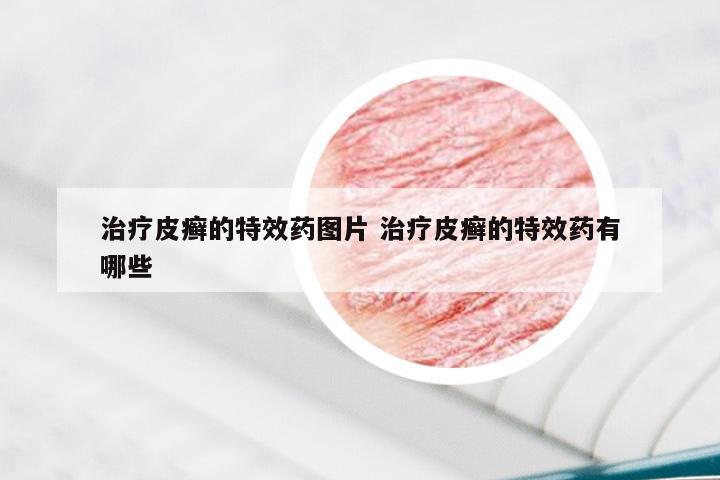 治疗皮癣的特效药图片 治疗皮癣的特效药有哪些