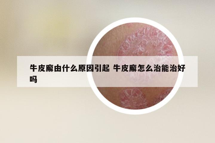 牛皮廨由什么原因引起 牛皮廨怎么治能治好吗