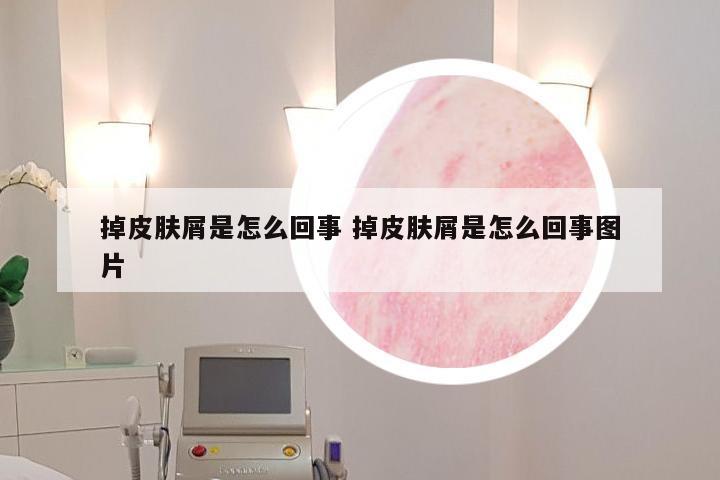 掉皮肤屑是怎么回事 掉皮肤屑是怎么回事图片