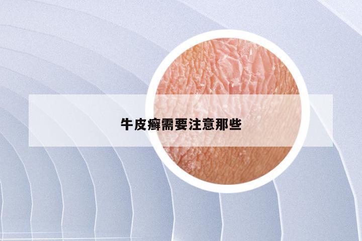 牛皮癣需要注意那些