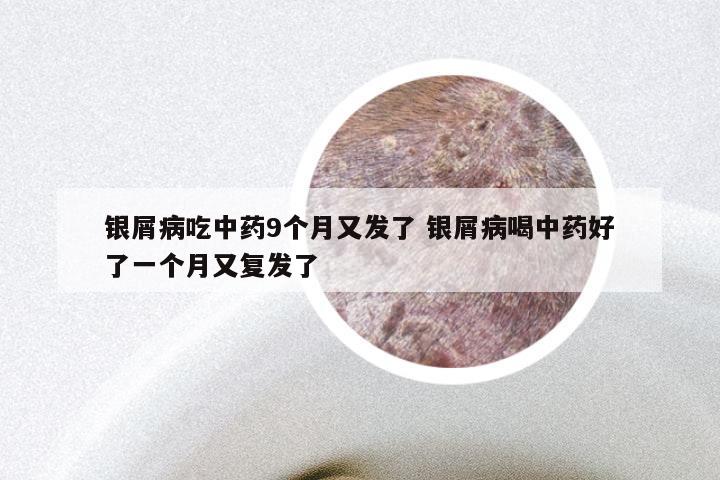 银屑病吃中药9个月又发了 银屑病喝中药好了一个月又复发了