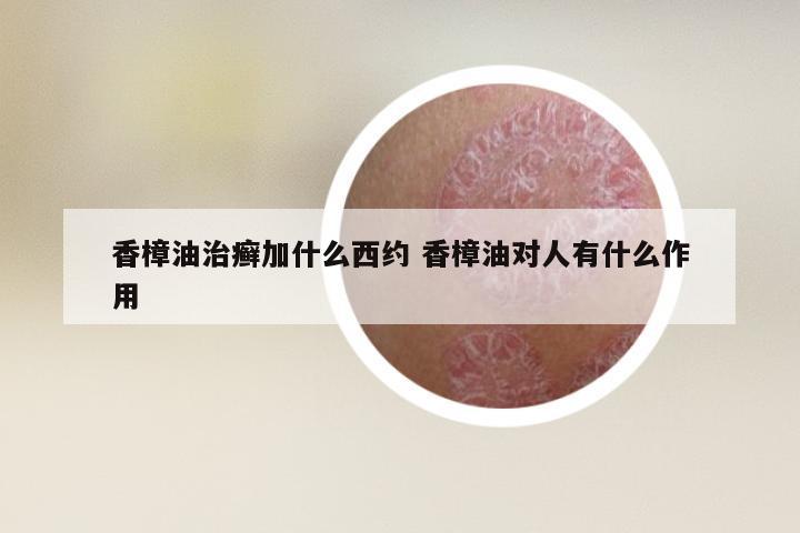 香樟油治癣加什么西约 香樟油对人有什么作用