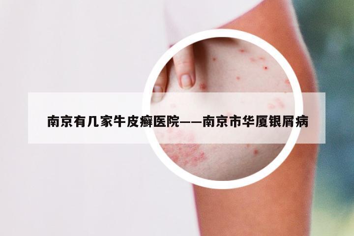 南京有几家牛皮癣医院——南京市华厦银屑病