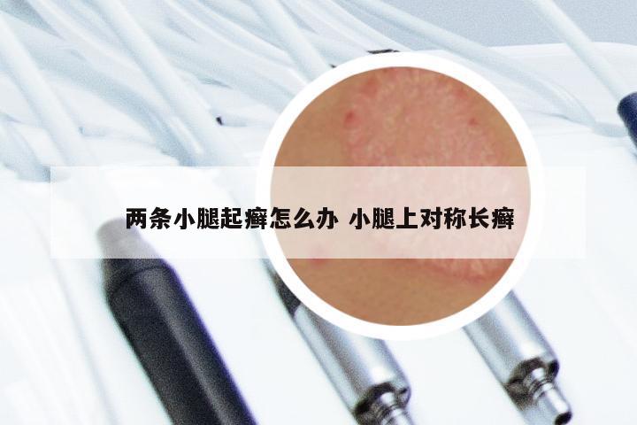 两条小腿起癣怎么办 小腿上对称长癣