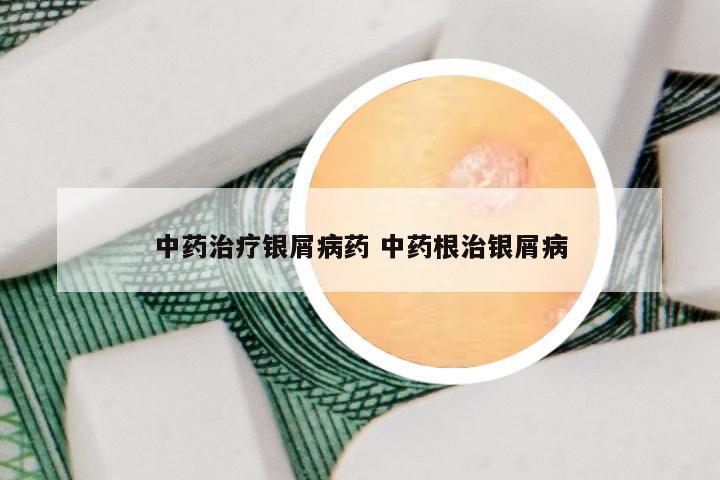 中药治疗银屑病药 中药根治银屑病