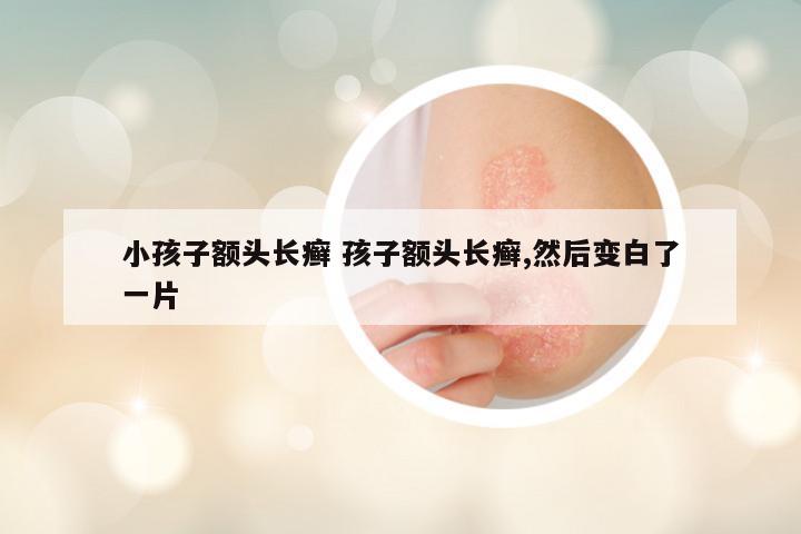 小孩子额头长癣 孩子额头长癣,然后变白了一片