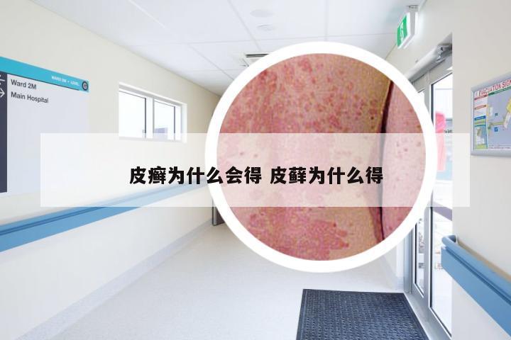 皮癣为什么会得 皮藓为什么得