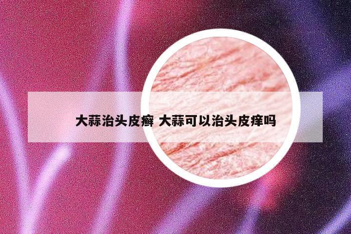 大蒜治头皮癣 大蒜可以治头皮痒吗