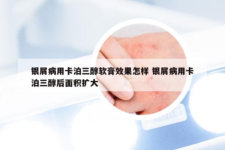 银屑病用卡泊三醇软膏效果怎样 银屑病用卡泊三醇后面积扩大