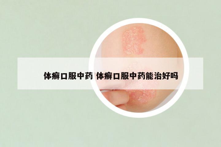 体癣口服中药 体癣口服中药能治好吗