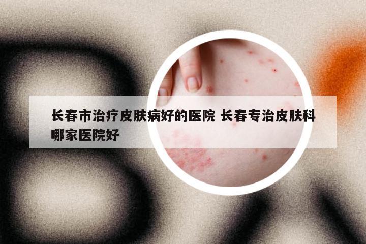长春市治疗皮肤病好的医院 长春专治皮肤科哪家医院好