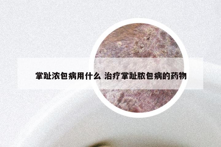 掌趾浓包病用什么 治疗掌趾脓包病的药物