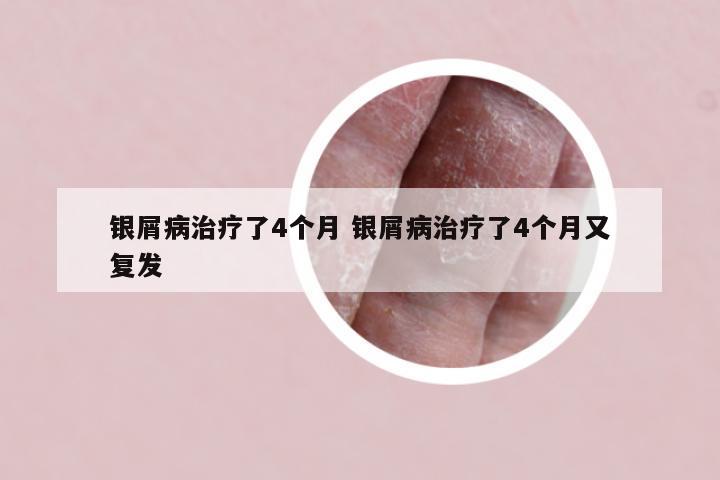 银屑病治疗了4个月 银屑病治疗了4个月又复发