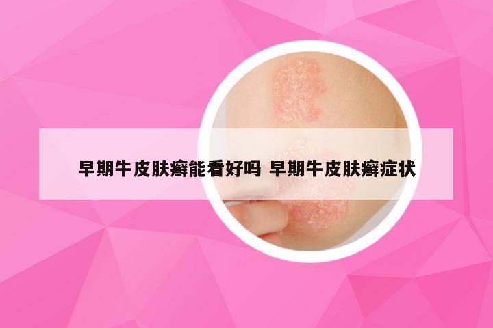 早期牛皮肤癣能看好吗 早期牛皮肤癣症状