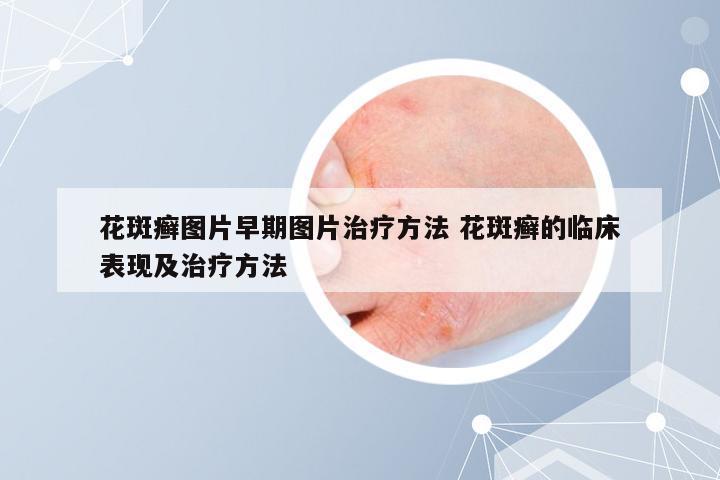 花斑癣图片早期图片治疗方法 花斑癣的临床表现及治疗方法