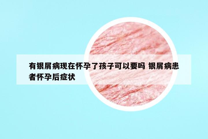有银屑病现在怀孕了孩子可以要吗 银屑病患者怀孕后症状