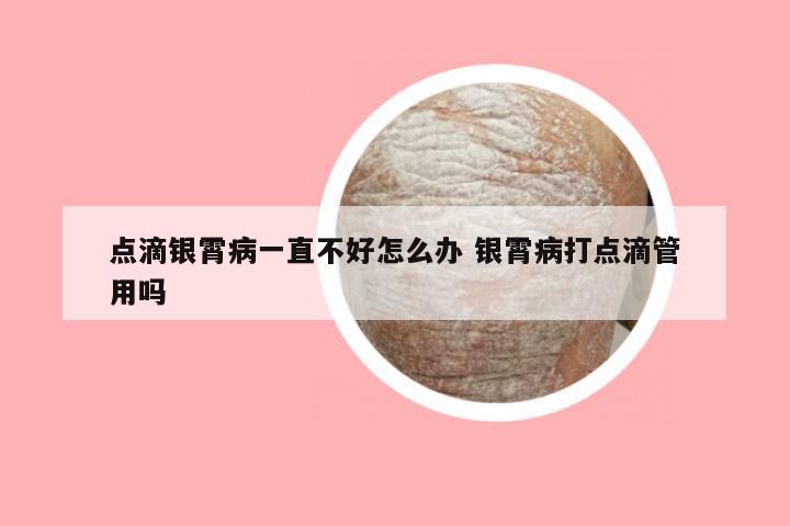 点滴银霄病一直不好怎么办 银霄病打点滴管用吗