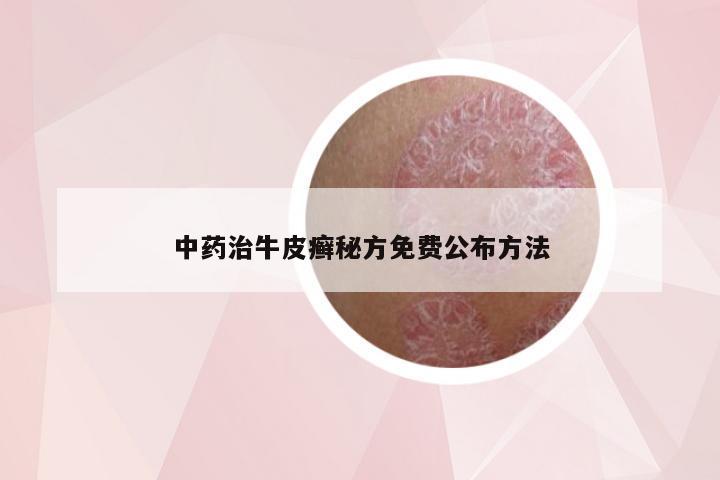 中药治牛皮癣秘方免费公布方法