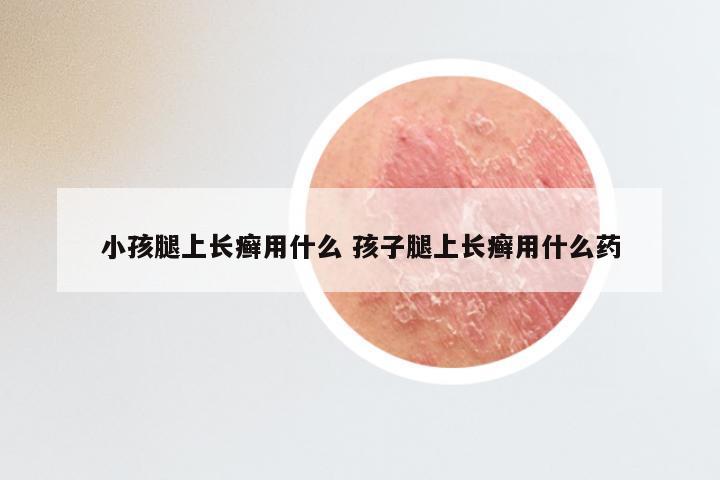 小孩腿上长癣用什么 孩子腿上长癣用什么药