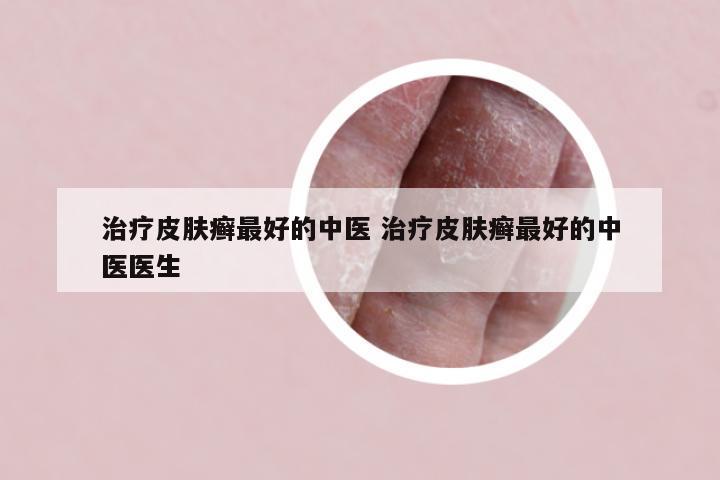 治疗皮肤癣最好的中医 治疗皮肤癣最好的中医医生