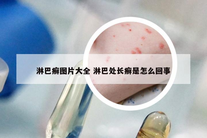 淋巴癣图片大全 淋巴处长癣是怎么回事