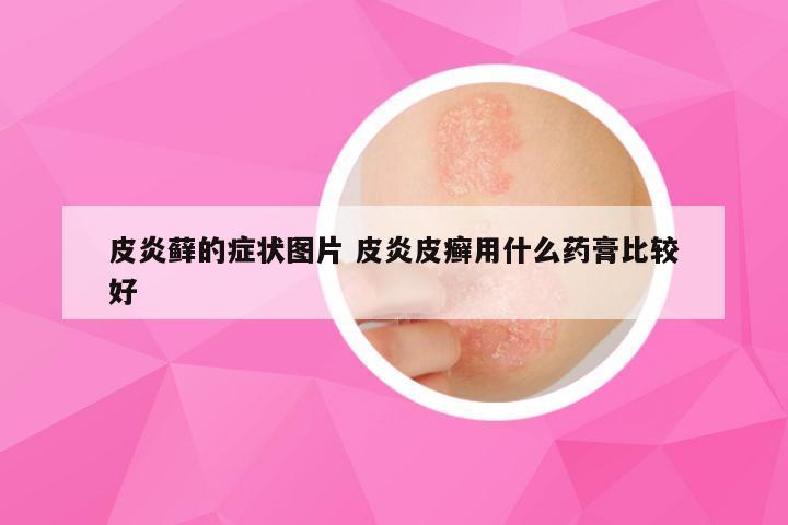 皮炎藓的症状图片 皮炎皮癣用什么药膏比较好