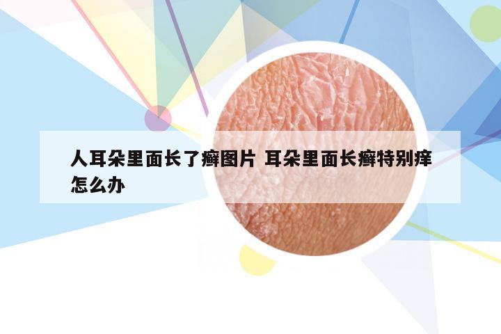 人耳朵里面长了癣图片 耳朵里面长癣特别痒怎么办