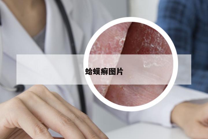 蛤蟆癣图片
