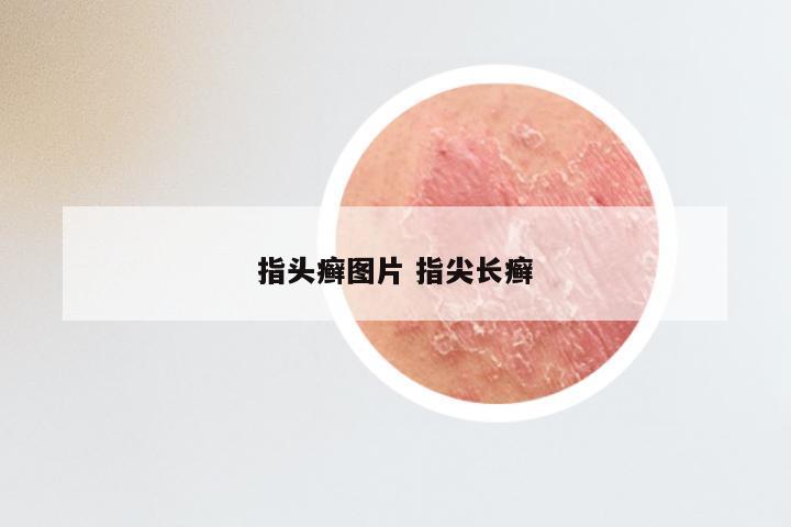 指头癣图片 指尖长癣