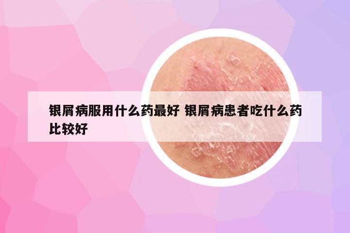 银屑病服用什么药最好 银屑病患者吃什么药比较好
