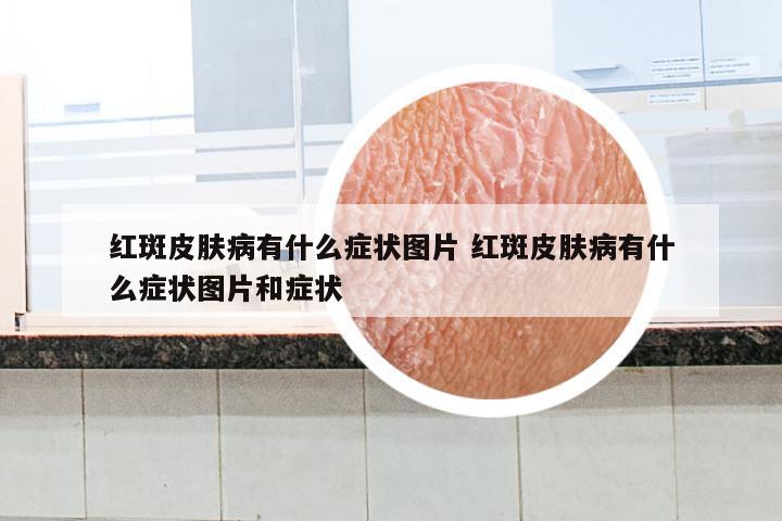 红斑皮肤病有什么症状图片 红斑皮肤病有什么症状图片和症状