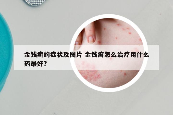 金钱癣的症状及图片 金钱癣怎么治疗用什么药最好?