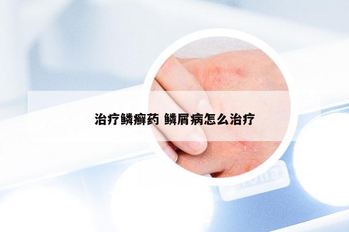 治疗鳞癣药 鳞屑病怎么治疗