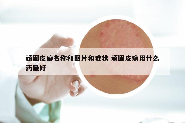 顽固皮癣名称和图片和症状 顽固皮癣用什么药最好