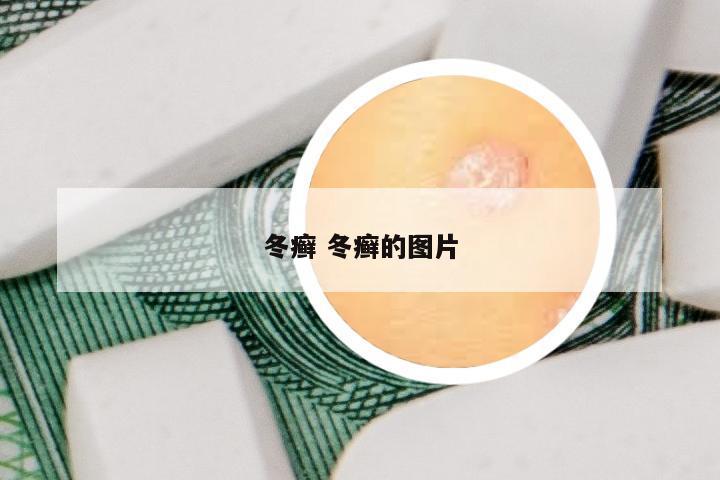 冬癣 冬癣的图片