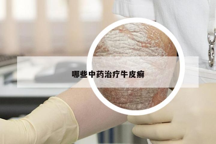 哪些中药治疗牛皮癣
