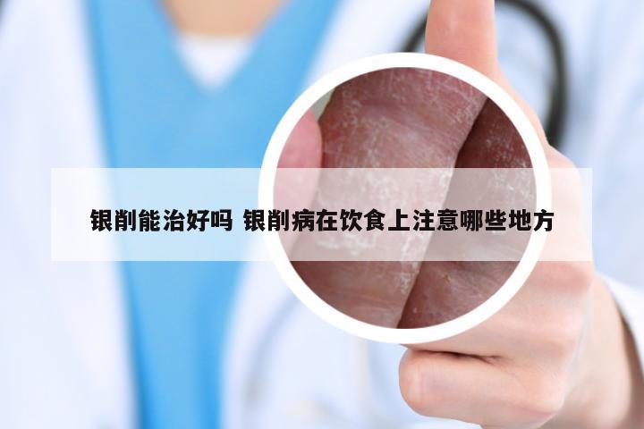 银削能治好吗 银削病在饮食上注意哪些地方