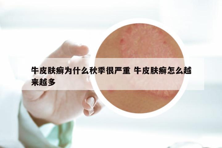 牛皮肤癣为什么秋季很严重 牛皮肤癣怎么越来越多