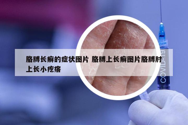 胳膊长癣的症状图片 胳膊上长癣图片胳膊肘上长小疙瘩