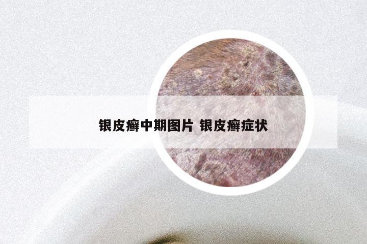 银皮癣中期图片 银皮癣症状
