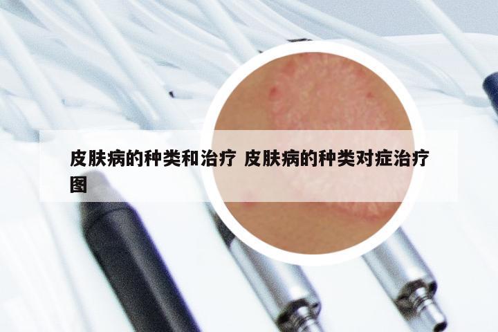 皮肤病的种类和治疗 皮肤病的种类对症治疗图