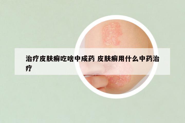 治疗皮肤癣吃啥中成药 皮肤癣用什么中药治疗