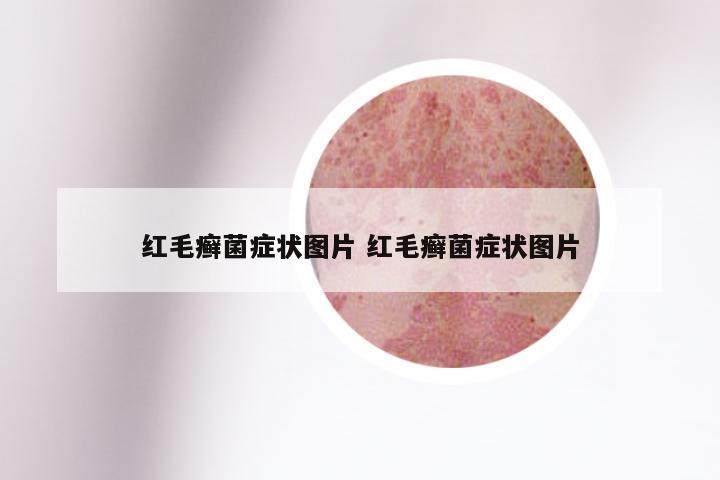 红毛癣菌症状图片 红毛癣菌症状图片