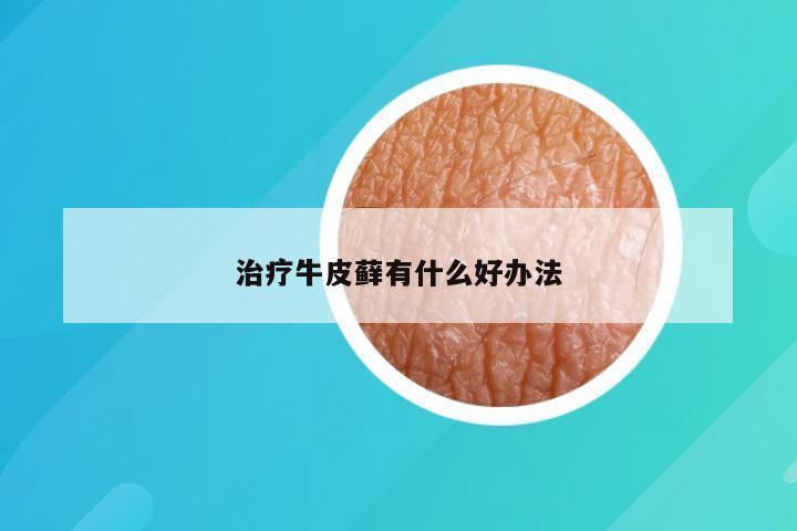 治疗牛皮藓有什么好办法