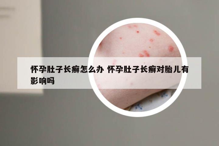 怀孕肚子长癣怎么办 怀孕肚子长癣对胎儿有影响吗