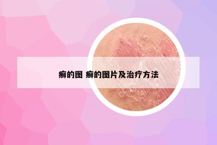 癣的图 癣的图片及治疗方法