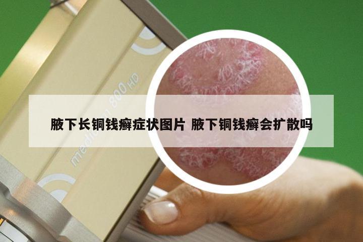 腋下长铜钱癣症状图片 腋下铜钱癣会扩散吗