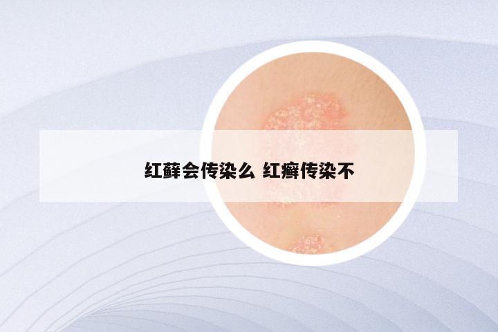 红藓会传染么 红癣传染不